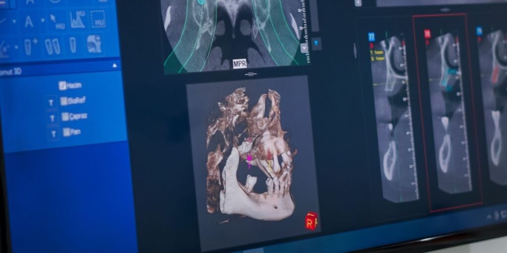 Temporomandibular Eklem Bozukluğu -3