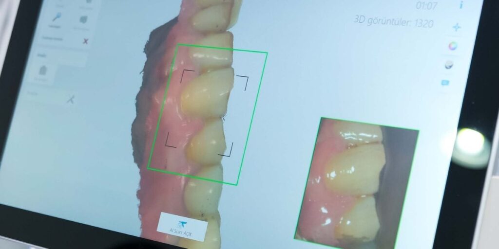 Protez ve Kaplama Tedavilerinde Ağız İçi Tarayıcıların Önemi