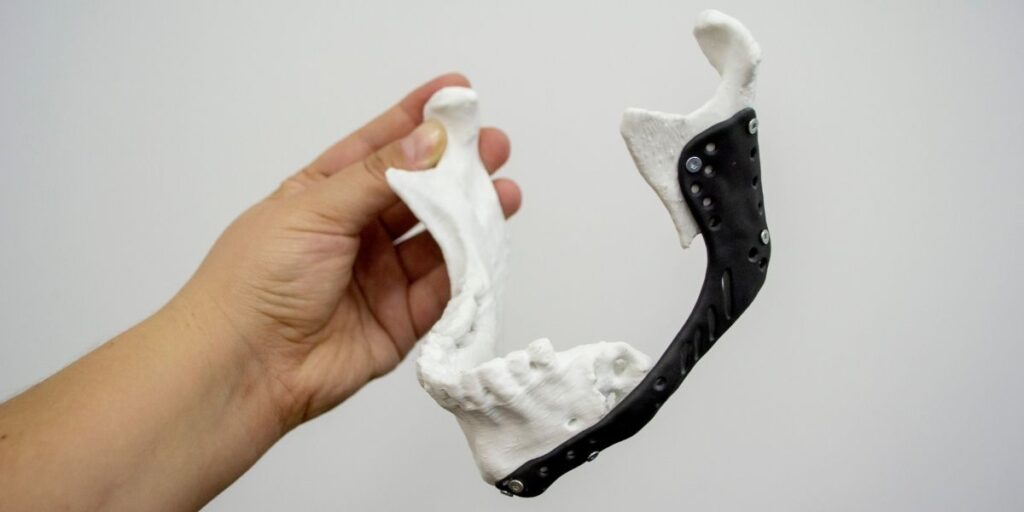 Alt Çene Kaymaları (Mandibula) Nasıl Düzeltilir_-2